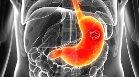 胃癌除了呕血胃溃疡，还有哪些“胃外”症状?